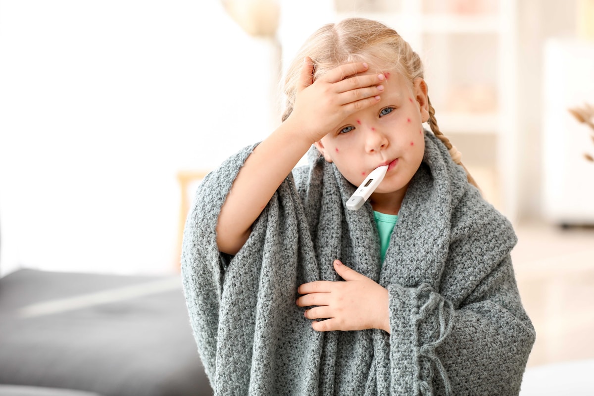 آبله مرغان تا چند روز واگیر دارد؟