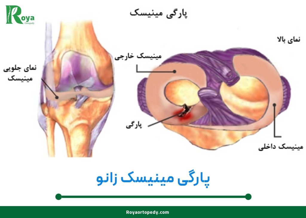 مینیسک زانو