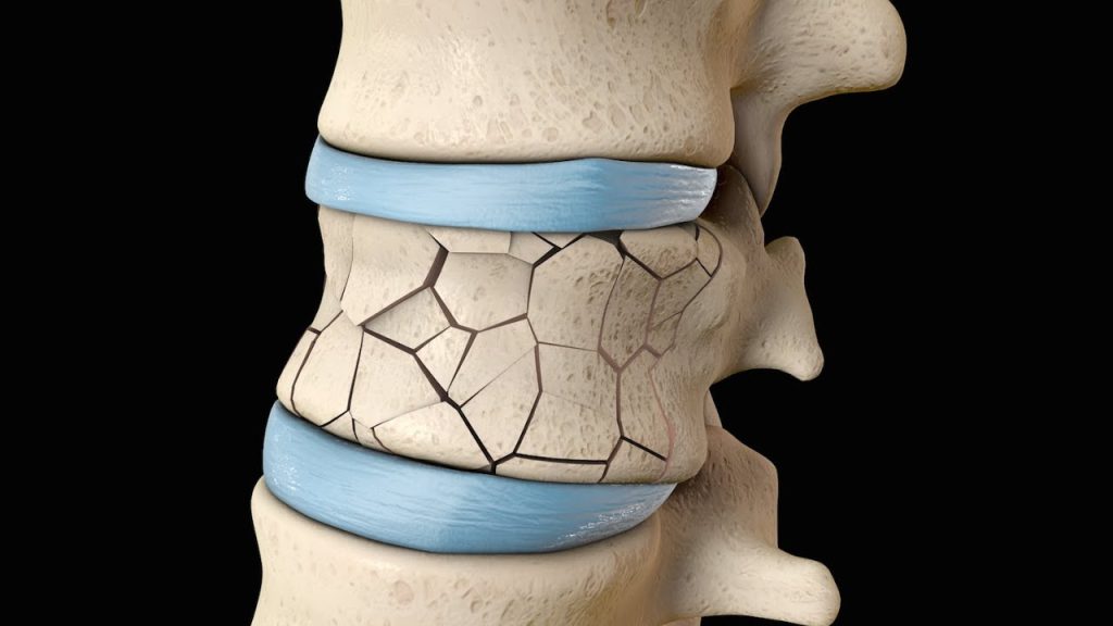 روش‌های تشخیص شکستگی مهره کمر