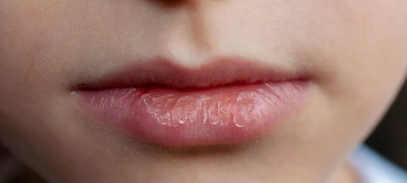 یکی از علائم کمآبی در کودکان
