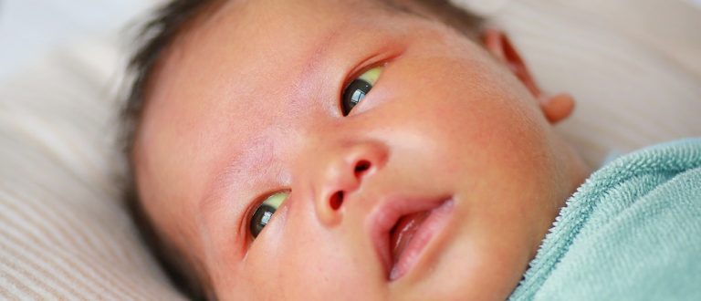 چرا نوزاد زردی میگیره؟