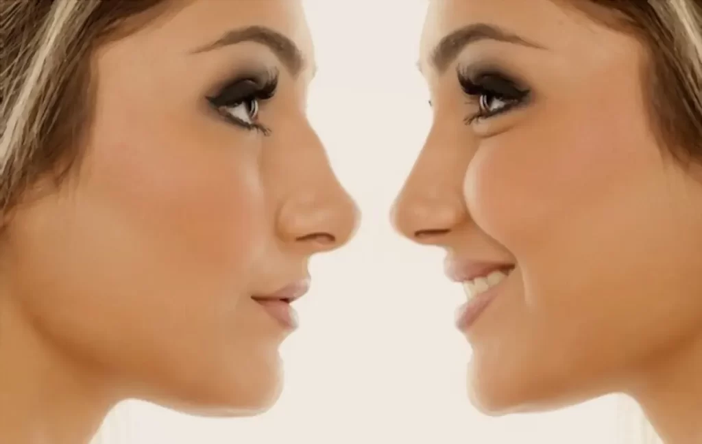 فیلر بینی برای چه سنی مناسب است؟