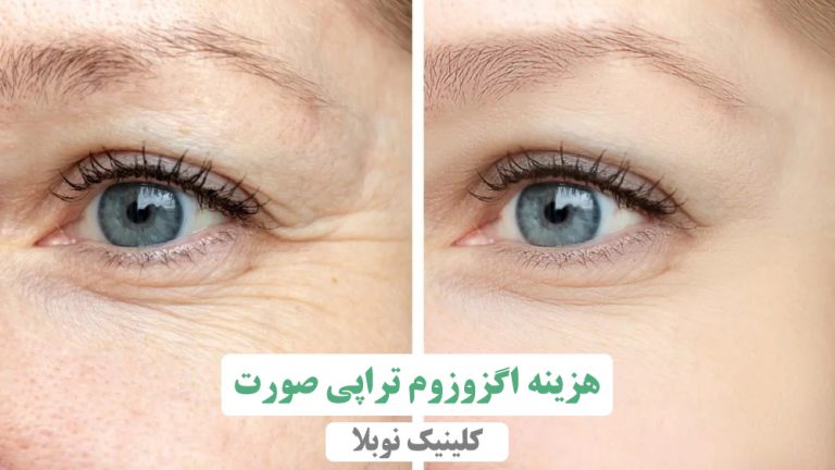هزینه اگزوزوم صورت
