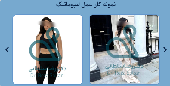 درد و عوارض پس از عمل لیپوماتیک ران پا چقدر است؟