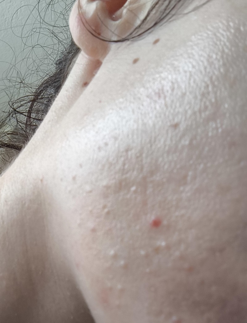 جوش‌های ناشی از تیغ زدن روی صورت