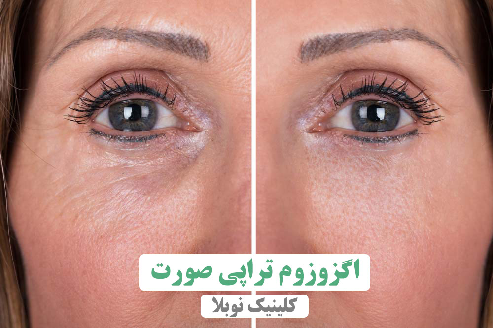 اگزوزوم تراپی صورت در تهران