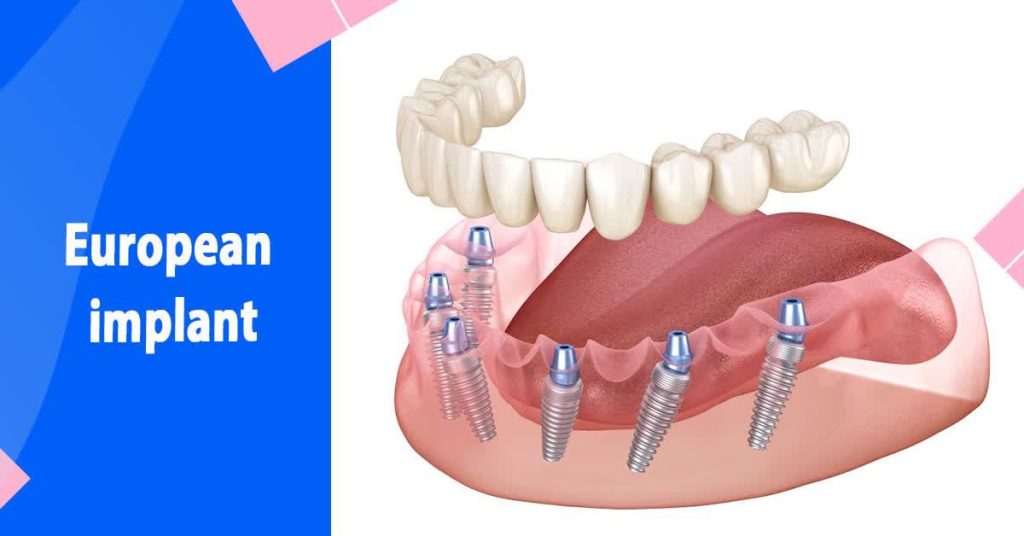 تفاوت های بین ایمپلنت اروپایی و کره ای