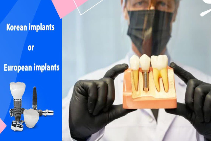 ایمپلنت دندان در اصفهان کره ای یا اروپایی؟ انتخاب اصفهانی ها کدام است؟