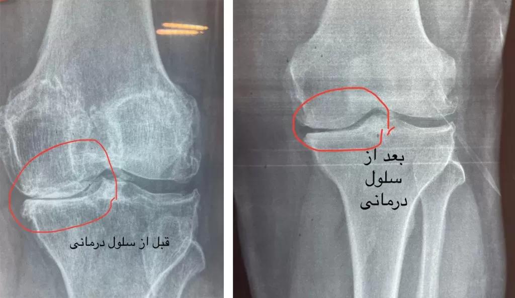ارتوپدی و تعویض مفصل و سلول‌درمانی زانو