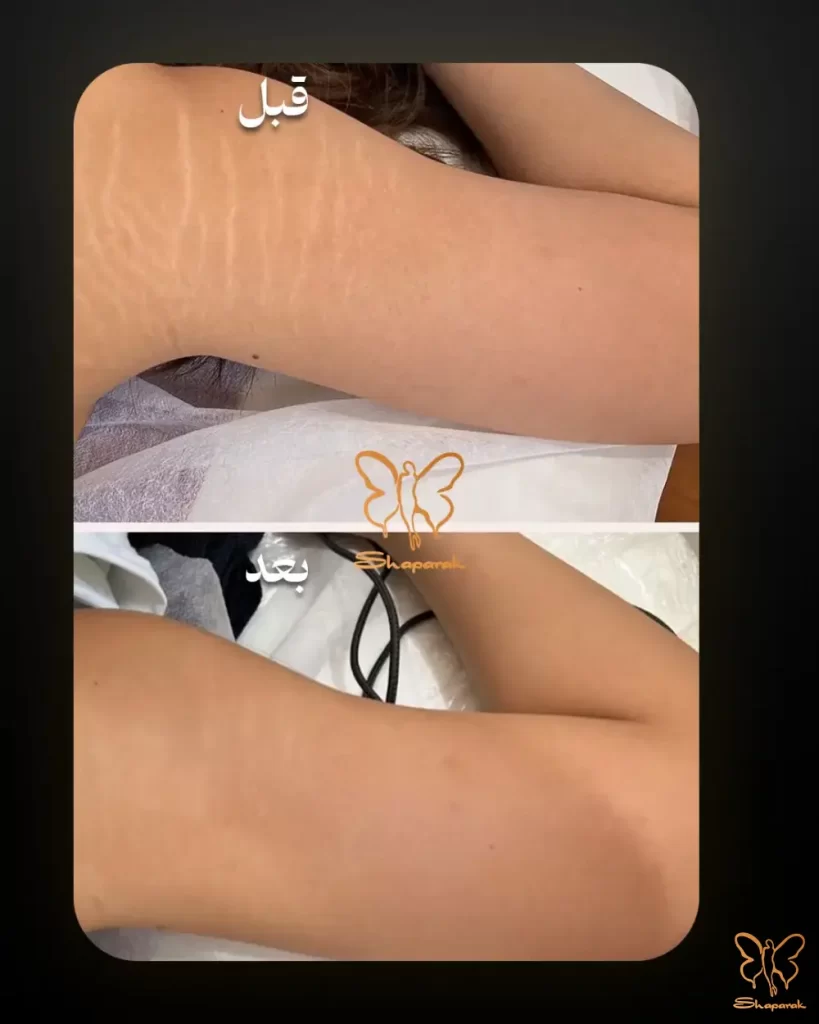 درمان ترکهای پوستی