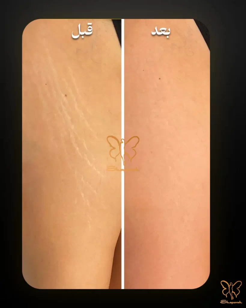 درمان ترکهای پوستی قبل و بعد