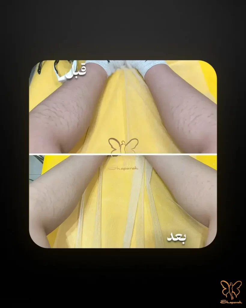 درمان ترکهای پوستی قبل و بعد