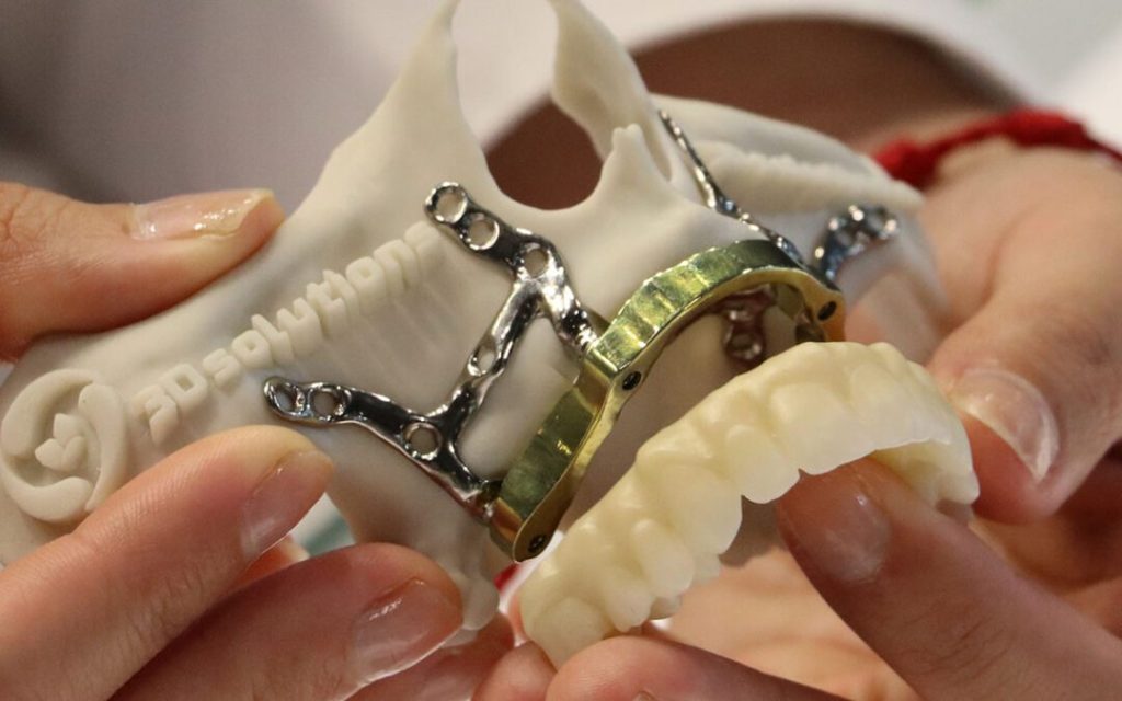 مزایا و چالش های ساب پریوستئال