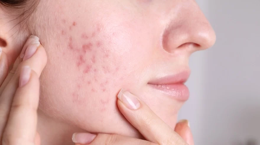 دلایل پنهان جوش