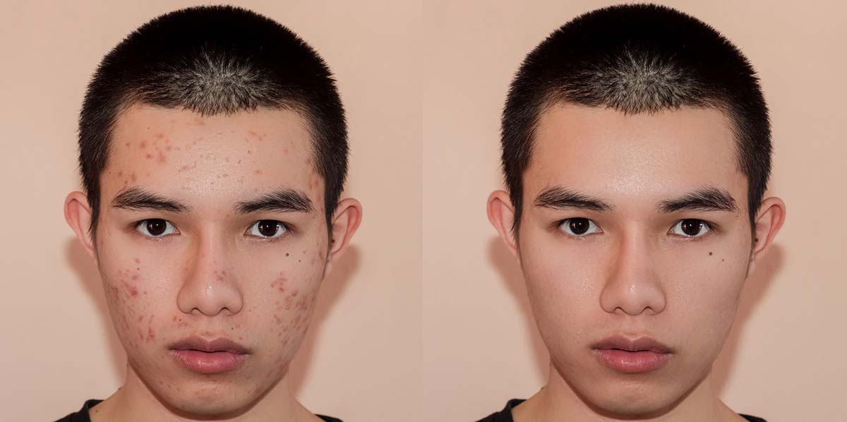 طرز استفاده از محلول کلیندامایسین برای درمان جوش: راهنمای کامل و ساده