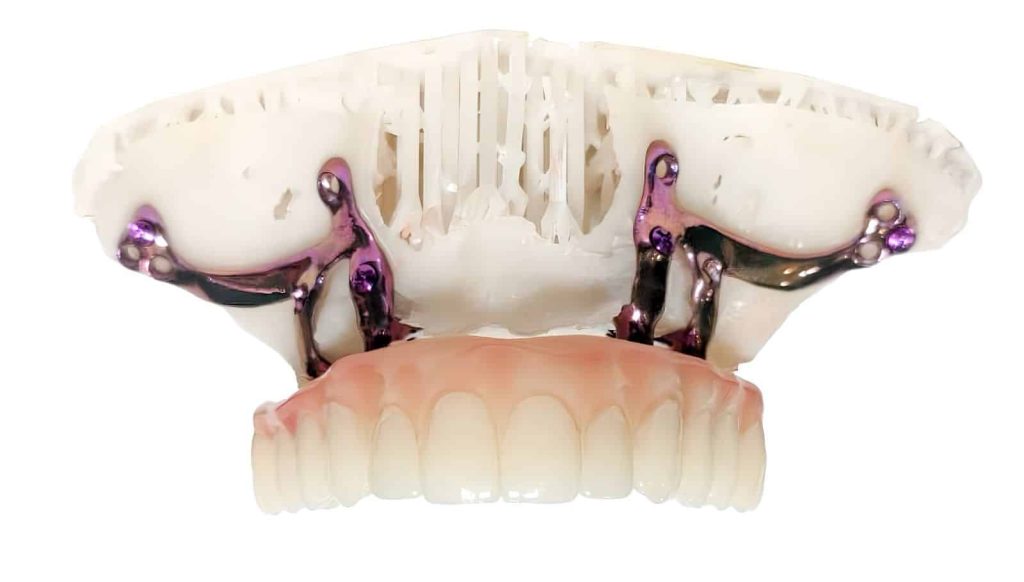 ایمپلنت ساب پریوستئال