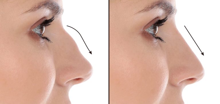 نظر کسانی که عمل بینی انجام داده‌اند: تجربیات مثبت و منفی واقعی بیماران ایرانی