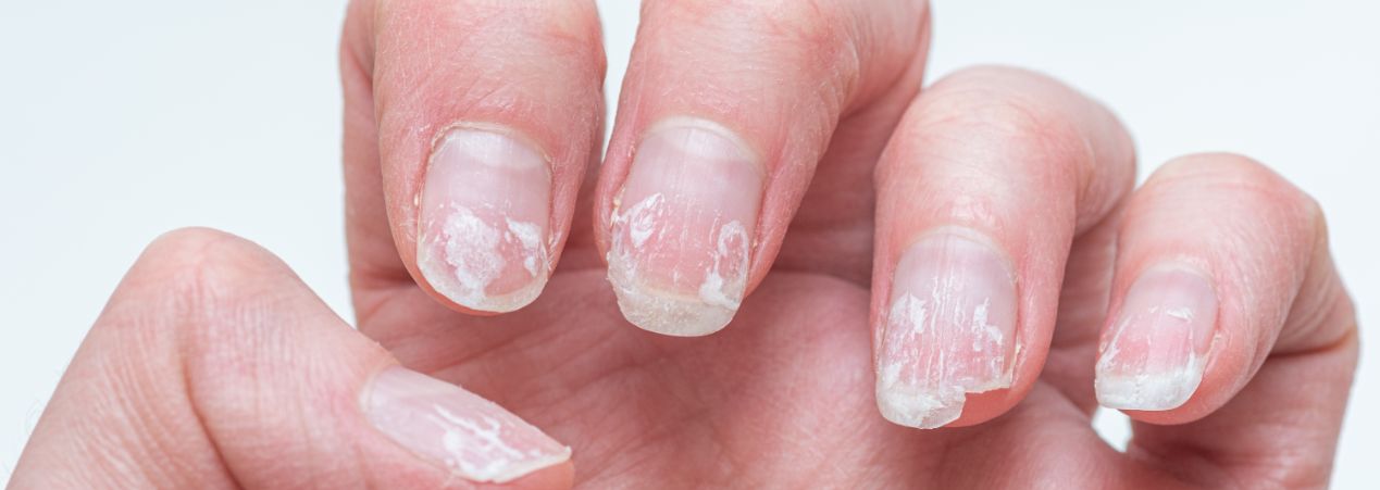 کمبود چه ویتامینی باعث ترک خوردن ناخن میشود​؟ | بررسی علل و راهکارهای تقویت ناخن‌ها