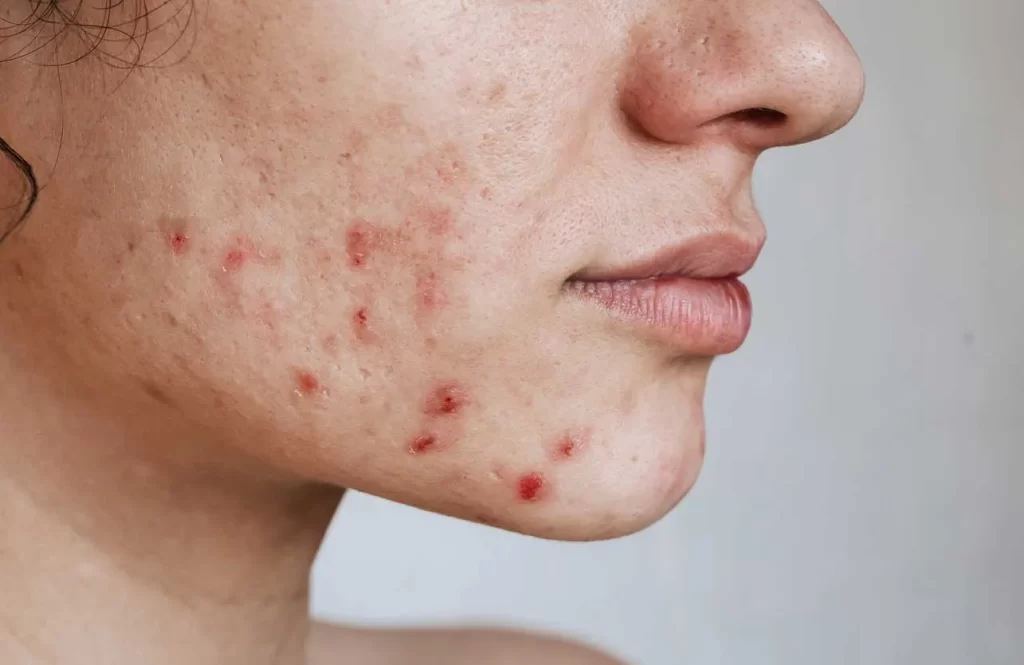 عوارض جانبی استفاده از محلول کلیندامایسین