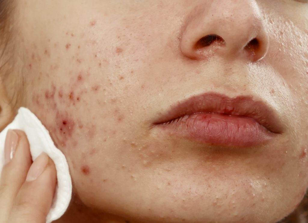 استفاده از محلول کلیندامایسین بدون رقیق کردن با آب