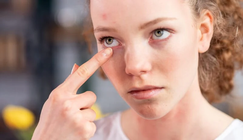 آیا سایه چشم باعث حساسیت میشود