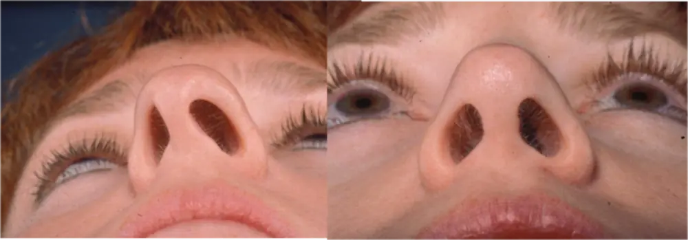 ورم و کجی کلوملا بینی بعد از عمل