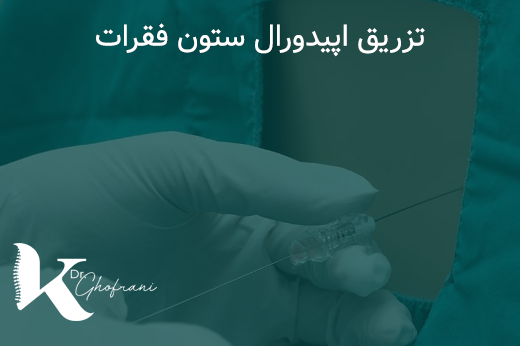 تزریق اپیدورال ستون فقرات