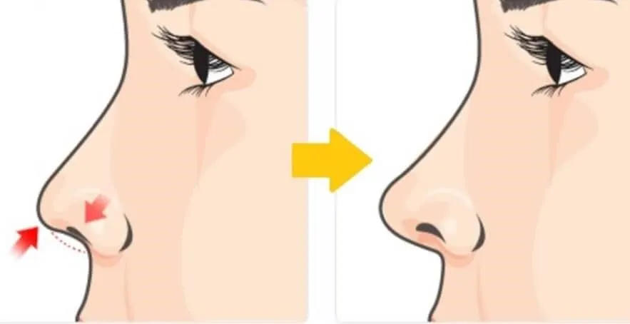 ورم و کجی کلوملا بینی بعد از عمل