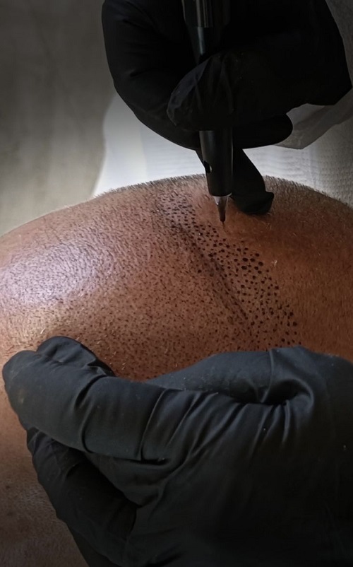 مهندسی کاشت گرافت تک‌مویی در خط رویش جهت جلوگیری از ظاهر موکتی و دستیابی به اثر سه‌بعدی