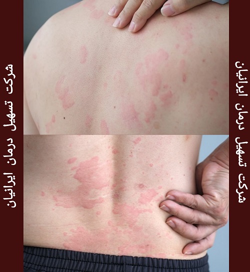 سوختگی لیزر موهای زائد