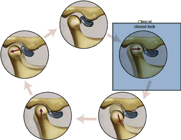 جابجای مفصل فک