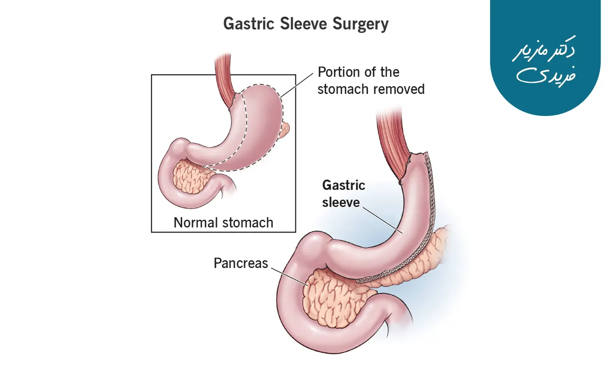 جراح اسلیو معده در تهران