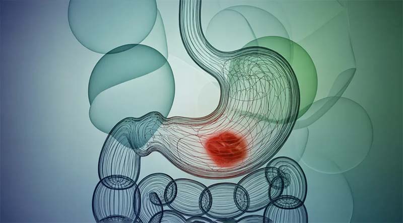 یکی از علت‌های خلط بعد از غذا خوردن؛ رفلاکس اسید معده