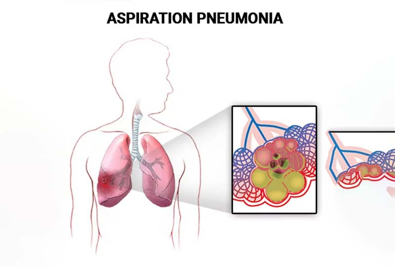 یکی از علت‌های خلط بعد از غذا خوردن؛ ورود مواد غذایی به مسیر تنفسی