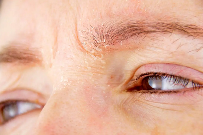 مشکلات پوستی فعال یکی از موانع شما برای لیفت ابروست