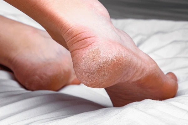 خشکی پوست کف پا