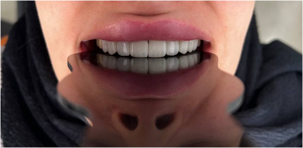 علتهای اصلی درد غیرطبیعی بعد از کامپوزیت