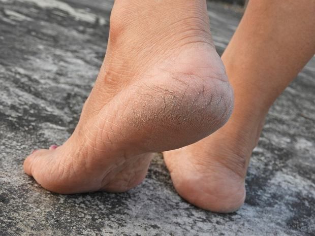 برای درمان ترک کف پا چه محصولات و راهکارهایی وجود دارد