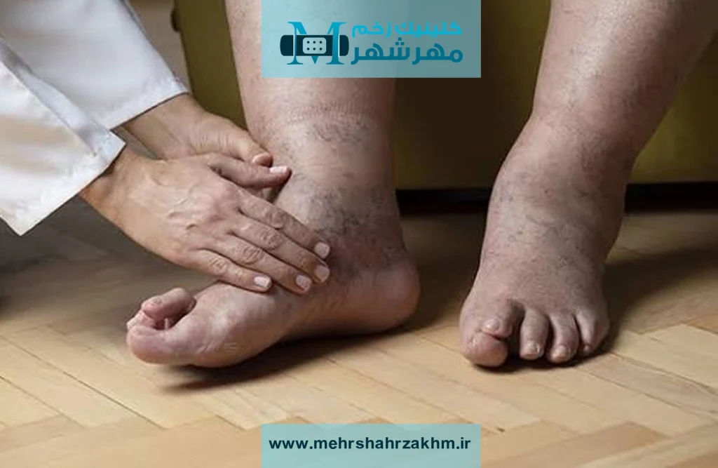 آیا درمان‌های خانگی می‌توانند زخم گیر کرده را درمان کنند؟