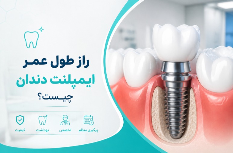 راز طول عمر ایمپلنت دندان چیست؟ بررسی مراقبت‌های لازم