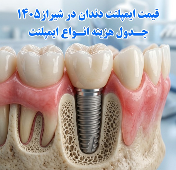 قیمت ایمپلنت دندان در شیراز 1405+ جدول هزینه انواع ایمپلنت