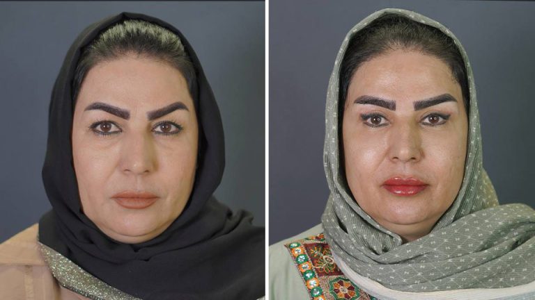 معرفی دکتر بلفاروپلاستی در مشهد + راهنمای انتخاب بهترین مرکز جراحی پلک