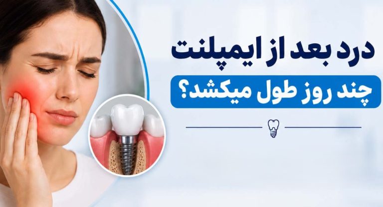 درد بعد از ایمپلنت چند روز طول می‌کشد